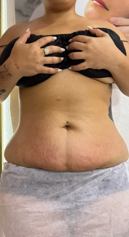 Abdomen después de los masajes reductores